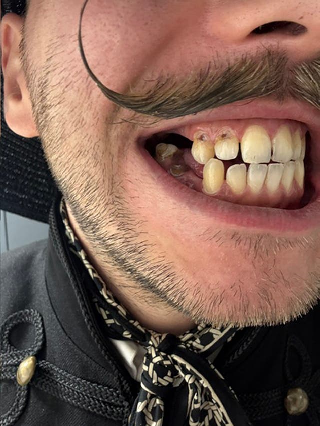 <p>Lajos Csendes’s teeth have ‘crumbled away’ over the years</p>